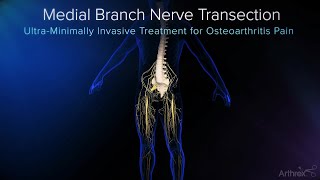 Endoscopic Medial Branch Nerve Transection [upl. by Flory]