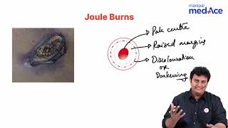 Forensic Medicine amp Toxicology  Joule burns [upl. by Giarg993]