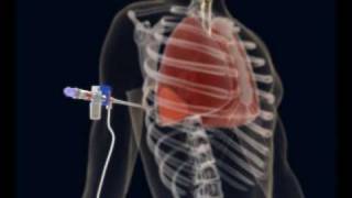 How to make a Thoracentesis pleural puncture with Pleurasafe [upl. by Gerik599]