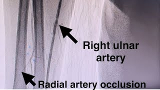 How To Puncture The Ulnar Artery in Ipsilateral Radial Artery Occlusion Anterior Puncture Technique [upl. by Nnylarat]