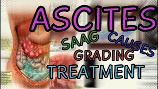 What are Ascites Transudate vs Exudate  SAAG  Fluid Wave Test  Shifting Dullness  Treatment [upl. by Neyu]