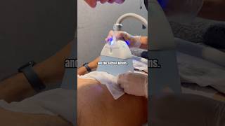 Fat freezing step by step 🧊🥶fatfreezing cryolipolysis fatloss shorts tyshorts formen clinic [upl. by Peterec]