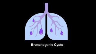 Bronchogenic Cysts Symptoms and Causes  Diagnosis  Treatment  Prevention disease healthcare [upl. by Odlaner]