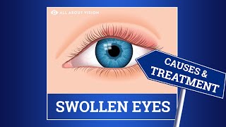 Swollen Eyelid Causes amp Treatment [upl. by Aecila]