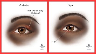 Chalazion vs Stye [upl. by Kirkpatrick]