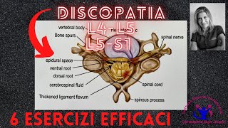 DISCOPATIA LOMBARE L4L5L5S1  6 ESERCIZI EFFICACI [upl. by Buskirk13]