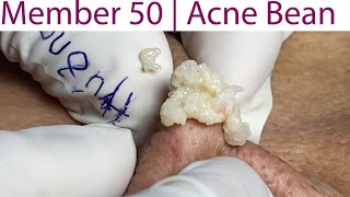 Acne Treatment Huong Da Nang 051  weekend  2023 [upl. by Lucilia]