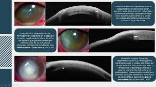Tomografía de Coherencia Óptica OCT en el Segmento Anterior [upl. by Elokkin844]