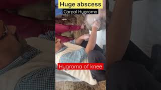 Hygroma of knee l carpal Hygroma l Dr Umar Khan [upl. by Danais]