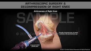 Arthroscopic Surgery amp Decompression of Right Knee [upl. by Ahsinot187]