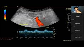 Doppler showing Stenosis of Carotid bifurcation NASCET criteria [upl. by Manheim]