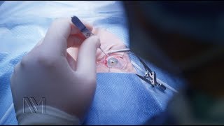 Strabismus Eye Surgery  Inside the OR [upl. by Aiyn]