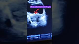 Uterine fibroidsultrasound imagesfibroidsintramural typeytshortshortvideo [upl. by Ib]