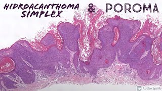 Poroma amp Hidroacanthoma Simplex dermatopathology dermatology pathology sweat gland tumors [upl. by Lusa566]