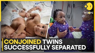 Conjoined Twins Successfully Separated After 8Hour Long Surgery  World News  WION [upl. by Runstadler]