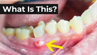 How to treat a tooth abscess [upl. by Ricoriki]