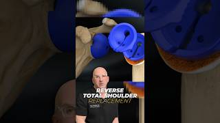 Shoulder Replacement Surgery What You NEED To Know [upl. by Antebi]