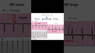 Cómo Identificar Tipos de Taquicardia en el Electrocardiograma  Dr Jose Porto [upl. by Violeta300]