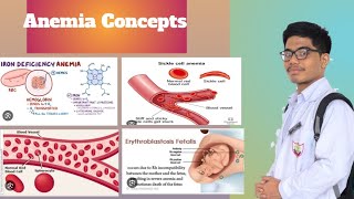 Iron Deficiency Anemia Hemolytic Anemia  Effects of Anemia on Heart [upl. by Yevre]