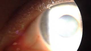 Bilateral tonic pupils vermiform pupil movement [upl. by Hanikahs]