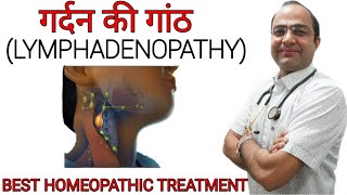 Swollen lymph nodes  Lymphadenopathy  गर्दन की गाँठ  Neck nodes swelling [upl. by Tammy]