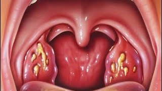 REMOVING TONSILS AND ADENOIDS [upl. by Howlyn]