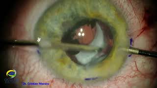 PCIOL secondary implantation in aphakic eye with history of trauma and traumatic cataract surgery [upl. by Assirat]