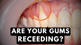 If Your GUMS are RECEDING You Need To Watch This [upl. by Liuqa]