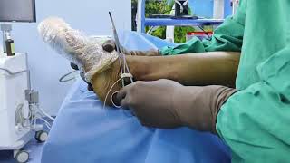 Peroneus longus tendon harvest for ACL Graft [upl. by Wilcox]