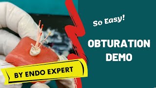 Obturation Made Easy ENDODONTICS DEMO [upl. by Tyoh]