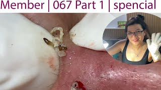 Acne Treatment Huong Da Nang 067 Part 1 Member [upl. by Hsan]