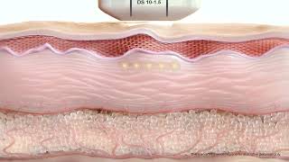 Ultherapy Prime mechanism of action video MOA US ULT 2400031 [upl. by Enialahs591]