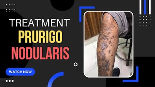 Prurigo Nodular Eczema Treatment ITCHY Skin bump एक्जिमा इलाज Dr Uttam Lenka [upl. by Yemorej455]