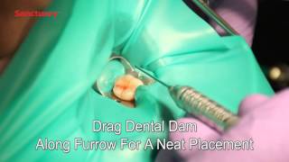 Placement of Sanctuary Dental Dam Clamps Premolar [upl. by Magocsi518]