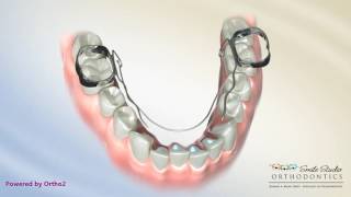 Bi HelixLower Orthodontic Appliance [upl. by Weidner]