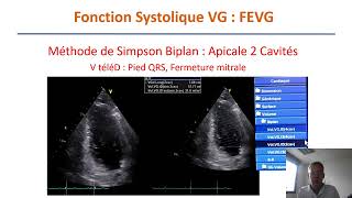 Présentation fonction systolique ventriculaire en échocardiographie transthoracique [upl. by Armallas]