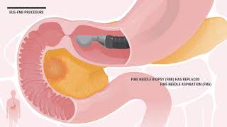 EUS endoscopic ultrasound FNB amp Intervention Animation amp explanation [upl. by Jasen440]