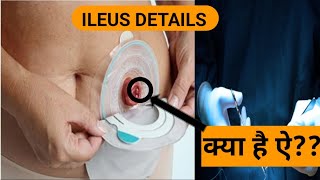 understanding ILEUS [upl. by Rock]