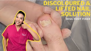 How To Treat Discolored amp Lifted Toenails Expert Tips For Healthy Nails with Pod Miss Foot Fixer [upl. by Cousin]