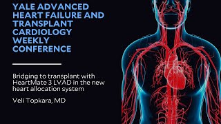 Bridging to transplant with HeartMate 3 LVAD in the new heart allocation system [upl. by Ahsikad]