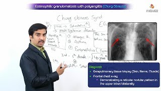 Eosinophilic granulomatosis with polyangiitis  ChurgStrauss Syndrome [upl. by Naylor]