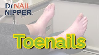 Throwback  Simple Toenail Cutting Neuropathy and Chemotherapy [upl. by Mitman]