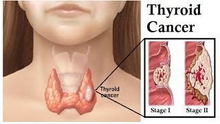 Episode57sherefusedsurgeryandinsteadusedcannabisoilforthyroidcancer [upl. by Shute]