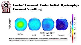 Fuchs Corneal Endothelial Dystrophy [upl. by Nahk425]