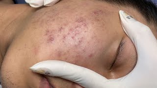 ACNE TREATMENT VU QUYNH MI Acne On Boys Chin 2024 [upl. by Netsrejk324]