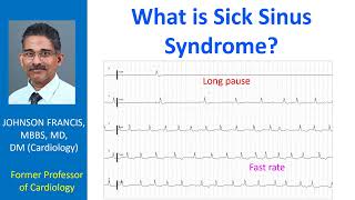 What is Sick Sinus Syndrome [upl. by Seagrave]