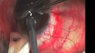 Intracapsular Cataract Extraction ICCE John Hovanesian MD [upl. by Ahsiemaj744]