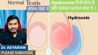 Hydrocele Video  Hydrocele कैसे होता है । Hydrocele का इलाज वीडियो हिंदी infection doctor [upl. by Rafferty91]