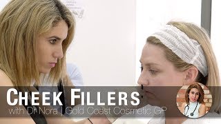 Cheek Dermal Fillers for Women  Before and After Transformation [upl. by Assirem]