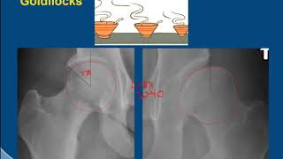 MRI Hip Imaging of Femoral Acetabular Impingement [upl. by Luanne]